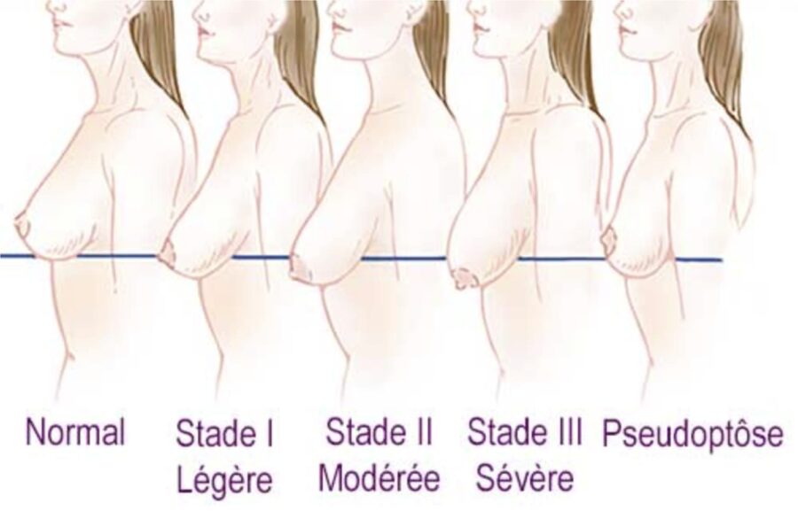Les-diffe?rents-stades-de-ptose-mammaire Schéma présentant es différents stades de ptose mammaire